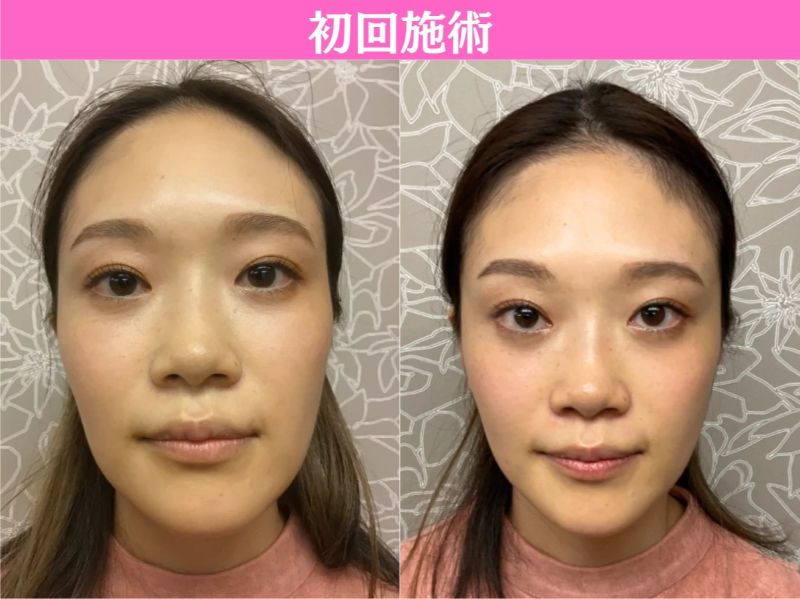 初回　小顔矯正