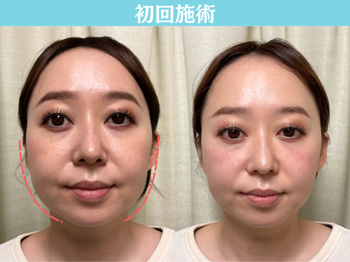 初回小顔矯正